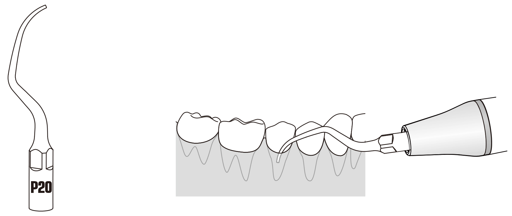 Сфера применения наконечника для скалера
